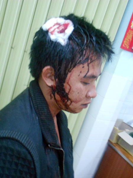 Vết thương trên người anh Sơn