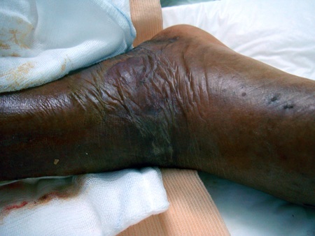 Vết thương trên chân bà Jũng