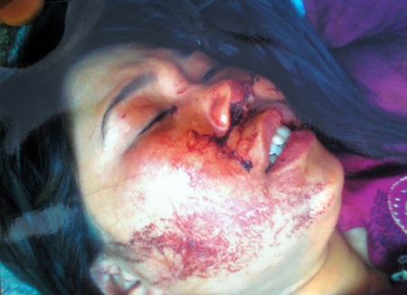 Vết thương trên mặt chị Vân
