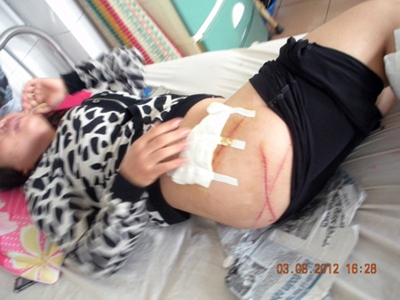 Vợ Chủ tịch xã đánh người dã man được hưởng án treo - 1 Vết thương của bà Vân trên cơ thể