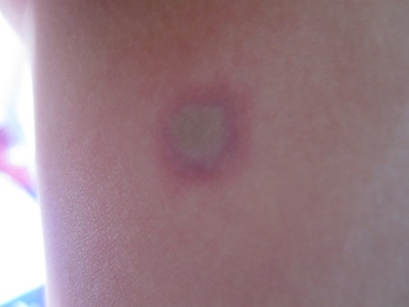 Vết thương bị hoại tử da do ong đốt trên cơ thể Huy