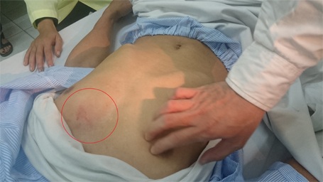 Vụ sắt rơi từ đường sắt trên cao: “Lúc đó mặt mũi tôi tối sầm lại” - 3 Vết bầm tím trên ngực trái ông Phong