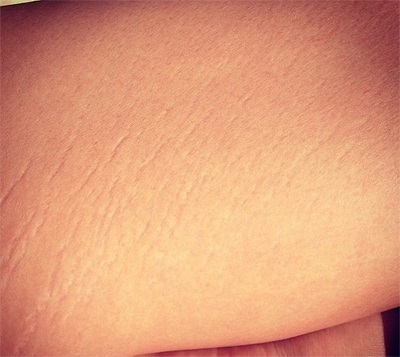 Siêu mẫu áo tắm tự tin “khoe”... vết rạn - 2 VN