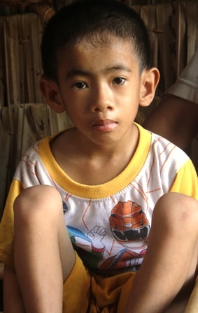 Bé Huy mắc bệnh tim từ nhỏ, giờ gây trơ xương do không có tiền phẫu thuật