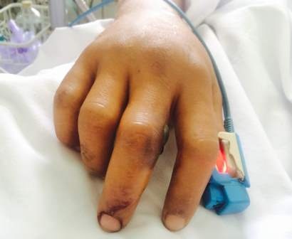 Tay bệnh nhân Điền bị sưng phù do rắn cắn