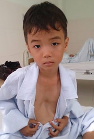 Cần Thơ: Phẫu thuật thành công cho bệnh nhân bị lõm xương ngực - 1 Bệnh nhân Võ Hoàng Việt bị lõm xương ngực và được phẫu thuật thành công