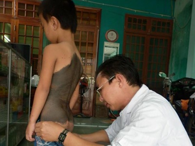 Tìm ra bệnh cậu bé mọc "lông" dày đặc - 1