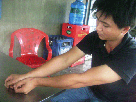 2 cánh tay anh Nguyễn Văn Đông phải khâu 14 mũi vì bị khỉ tấn công.