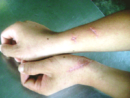 2 cánh tay anh Nguyễn Văn Đông phải khâu 14 mũi vì bị khỉ tấn công.