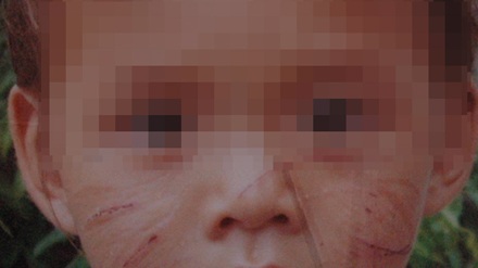 "Ngứa mắt", 4 lần dùng kéo rạch mặt bé trai mới 20 tháng tuổi  - 1 Khuôn mặt chằng chịt vết sẹo của cháy V.V.T.