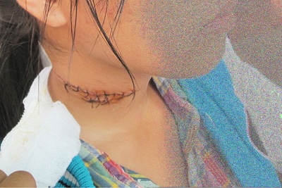 Con tự rạch cổ vì cha mẹ “cuồng tín” - 2 Vết thương khâu 12 mũi trên cổ H.