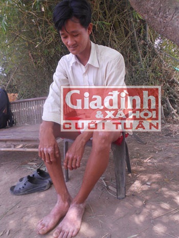 Anh Hây sầu khổ với căn bệnh lột da của mình