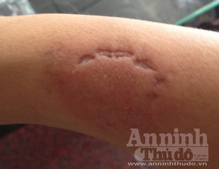 Gái mại dâm dùng võ... răng tấn công lực lượng chức năng - 1 Vết răng trên tay đồng chí Nguyễn Mạnh Cường