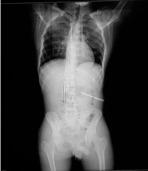 Kinh hãi thanh niên bị thủng dạ dày vì nuốt đinh và lưỡi cưa - 1 Hình ảnh chụp X-Quang chiếc đinh và lưỡi cưa đang nằm trong người Xiao Gong.