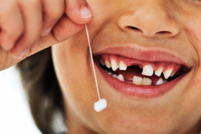 Có nên nhổ răng sữa ở trẻ em? - 1 Nhổ răng sữa khi mới bắt đầu lung lay, có nguy cơ phá vỡ cấu trúc răng của trẻ. Ảnh minh họa
