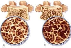 Phân biệt bệnh nhuyễn xương và loãng xương - 1 Hình ảnh xương bình thường (a) và xương bị loãng (b).