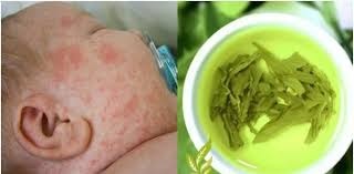 Trị rôm sảy cho trẻ bằng trà xanh rất công hiệu - 1 Trị rôm sảy cho trẻ bằng trà xanh rất công hiệu - 1