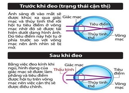 Điều trị cận thị không phẫu thuật với kính áp tròng SEED Ortho-K - 2