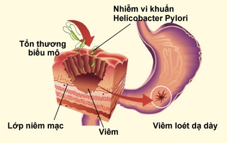 6 điều quan trọng về viêm loét dạ dày ai cũng cần biết - 1 6 điều quan trọng về viêm loét dạ dày ai cũng cần biết - 1