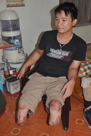 Bố cụt hai chân gồng gánh nuôi vợ và con bị bệnh “lột da ếch” - 9
Anh Soạn ước có một chiếc xe lăn để anh có thể di chuyển dễ dàng hơn