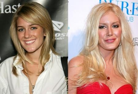 Khi mới xuất hiện trong phần đầu loạt phim “The Hills”, Heidi Montag có diện mạo khá bình thường. Tuy nhiên, do chứng “nghiện” phẫu thuật thẩm mĩ nên Heidi không tiếc tiền đầu tư cho dao kéo và thực hiện một loạt ca “trùng tu” nhan sắc. Kết quả, những nét đẹp tự nhiên ban đầu đã hoàn toàn biến mất trên người nữ diễn viên xinh đẹp.