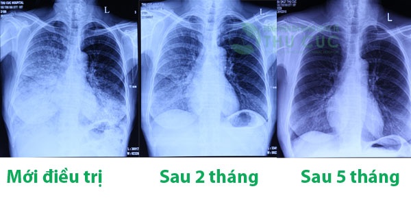 Ung thư phổi dễ bị chẩn đoán nhầm với các bệnh khác - 2 Kết quả sau 5 tháng điều trị hóa chất của bà V.T.H. Nếu như ban đầu, khối u lan gần kín phổi khiến cho người bệnh không tự thở được thì sau 5 tháng điều trị, khối u gần như biến mất, người bệnh có thể tự thở được, sức khỏe tốt.