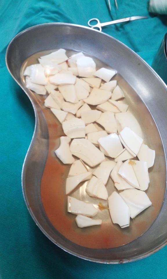Kinh hoàng gắp 59 mảnh sành sắc nhọn trong bụng bệnh nhân - 1
59 mảnh sành được gắp ra khỏi đường ruột, dạ dày bệnh nhân. Ảnh: BS cung cấp