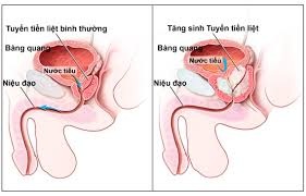 U xơ tuyến tiền liệt: Đồng hành với tuổi tác - 2 Những dấu hiệu khi bị u xơ tiền liệt tuyến