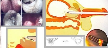 U xơ tuyến tiền liệt: Đồng hành với tuổi tác - 6 U xơ tuyến tiền liệt: Đồng hành với tuổi tác - 6