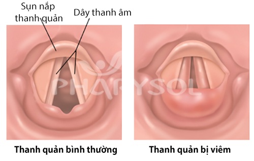Chấm dứt nỗi lo viêm thanh quản - 1 Chấm dứt nỗi lo viêm thanh quản - 1