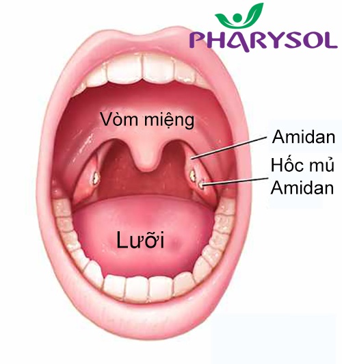3 vấn đề quan trọng người bị viêm amidan cần biết ! - 1 3 vấn đề quan trọng người bị viêm amidan cần biết ! - 1