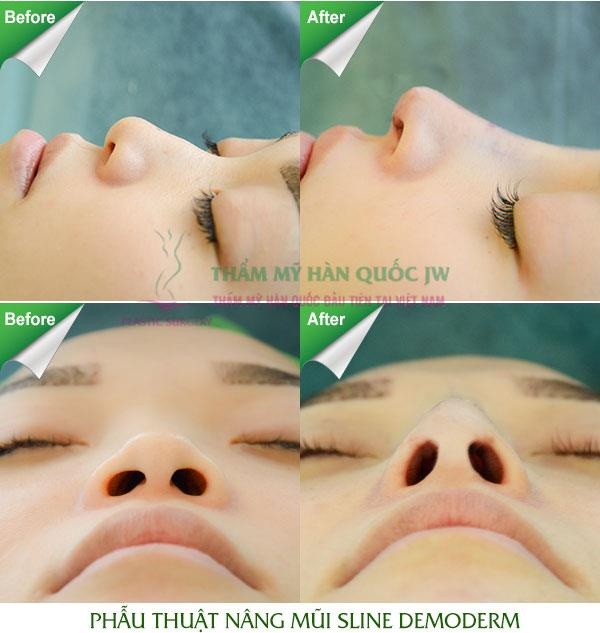 Nâng mũi s line có nhất thiết phải gây mê hay không? - 3 Khách hàng được nâng mũi S line tiền mê và bọc vật liệu cao cấp Demoderm – Kỹ thuật tiên tiến và độc quyền duy nhất tại JW.