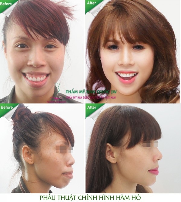 700 ca phẫu thuật hô móm không cần niềng răng và lời khuyên từ chuyên gia - 2 Nữ diễn viên múa Nguyễn Thị Lan (Leader Vũ đoàn Bước Nhảy, chuyên biên đạo múa cho nhiều ca sĩ nổi tiếng như Đông Nhi, Minh Hằng…) là minh chứng phản ánh rõ nhất về sự thay đổi ngoạn mục cả về nhan sắc lẫn sự nghiệp sau khi phẫu thuật hàm hô với bác sĩ Tú Dung. Cô hiện lọt top 6 cuộc thi So you think you can dane 2015