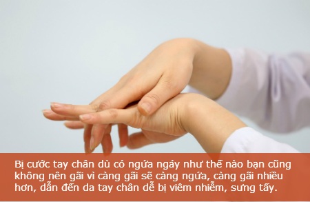 Mẹo phòng tránh và chữa cước tay chân mùa lạnh - 11