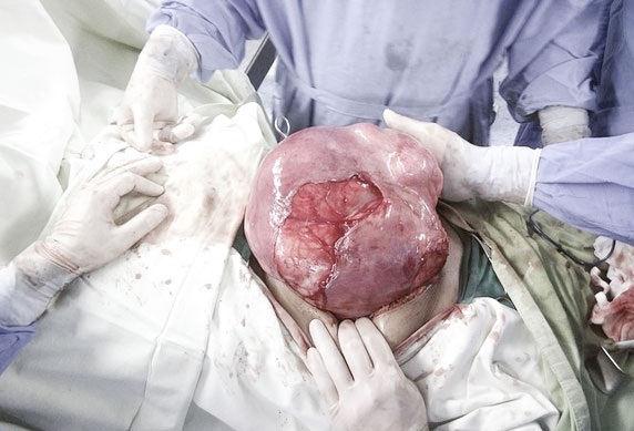 Lấy thành công khối u to như quả dưa hấu ở bụng dưới - 1 Khối u nặng 6,5kg được lấy ra khỏi bụng