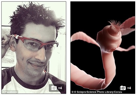 Đau nửa đầu dữ dội vì… sán làm ổ trong não - 1 Sử dụng máy nội soi, BS Soren Singel mở một lỗ trên hộp sọ của Luis, sát lông mày của anh. Ông cho biết: “Chúng tôi đưa camera vào giữa não và gắp con sán ra”. Bên phải là hình ảnh minh họa của sán dây