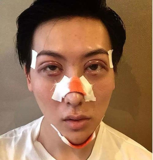 
Liu Zi Chen sau ca phẫu thuật chỉnh sửa gương mặt. Lúc này, Liu vẫn đang là đàn ông.
