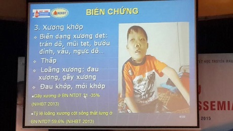 Bệnh tan máu bẩm sinh - Quả bom nguyên tử đã nổ ở Việt Nam - 3 Bệnh tan máu bẩm sinh - Quả bom nguyên tử đã nổ ở Việt Nam - 3