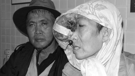 "Trốn" chỉ định của bác sĩ, bệnh nhân “mọc thêm đầu” trên mặt - 3
Ông Quý đưa vợ trở lại Chợ Rẫy khi khối thịt lớn đã lồi to như quả dừa