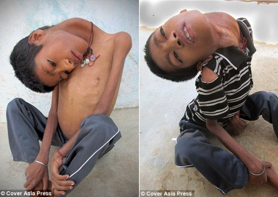 
Mahendra bị người dân cùng làng xa lánh vì có đầu gập 180 độ.
