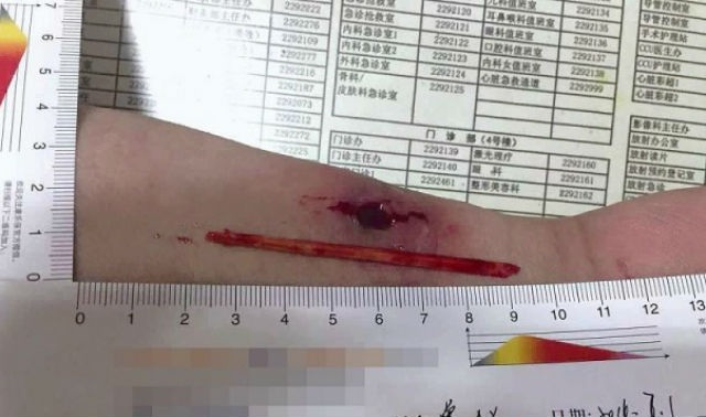 
Chiếc đũa gẫy cắm trong cánh tay anh Zeng
