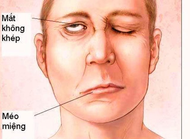 Gió lạnh thất thường, đề phòng liệt mặt, méo miệng thế nào? - 1 Gió lạnh thất thường, đề phòng liệt mặt, méo miệng thế nào? - 1