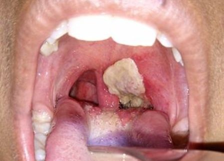 Bệnh bạch hầu - Nguyên nhân khiến 3 người chết ở Bình Phước - 1 Họng bệnh nhân mắc bạch hầu thường bị viêm nặng, kết màng trắng