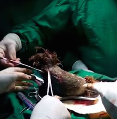 Lấy ra búi tóc nặng gần 1 kg trong bụng bé gái 17 tuổi - 2
Búi tóc nặng gần 1kg chiếm gần như toàn bộ phần dạ dày của cô gái 17 tuổi.