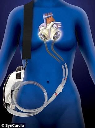 Kỳ diệu sống hơn một năm rưỡi mà không cần tim - 2
Quả tim di động của Stan.