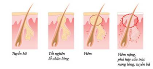 Dùng thuốc điều trị và phòng ngừa mụn như thế nào? - 2 Cơ chế hình thành mụn.