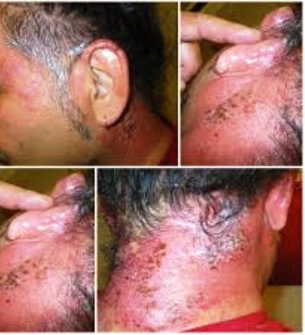 Xài ‘thần dược’ chống hói, lông lá mọc đầy người - 3 Lở loét da đầu vì xài thuốc mọc tóc dỏm