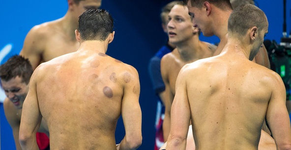 Giác hơi: Bí quyết thành công của kình ngư Mỹ Michael Phelps? - 1
Vận động viên bơi lội Michael Phelps với những vòng tròn màu tím trên lưng và vai khi anh giành Huy chương vàng vào tối Chủ Nhật (Ảnh: Doug Mills/The New York Times)