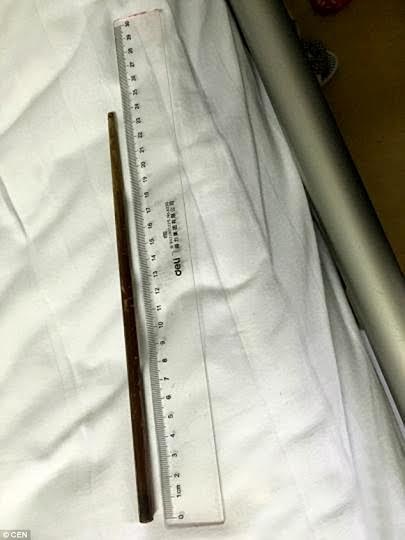 Vẫn sống sót dù nuốt đũa vào bụng suốt ba tháng - 1
Cây đũa dài 24cm nằm trong bụng suốt 3 tháng.