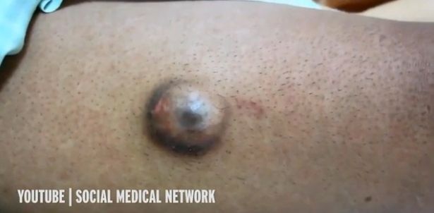 Hết hồn khối u “quái thú” giống như đôi mắt người - 2 Hết hồn khối u “quái thú” giống như đôi mắt người - 2